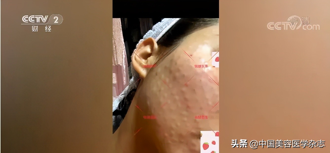 水光针水货跟假货的区别,央视点评水光针