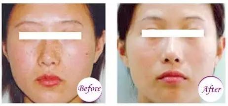 激光超皮秒祛斑后需要注意什么,激光祛斑后反黑了可以再去激光吗