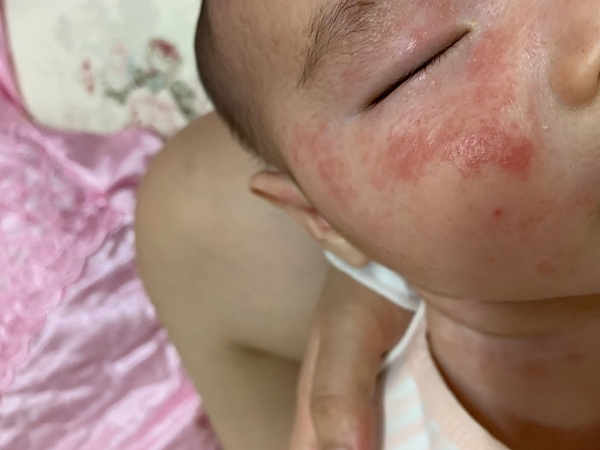 宝宝夏天湿疹严重怎么办,宝宝夏天湿疹怎么消除