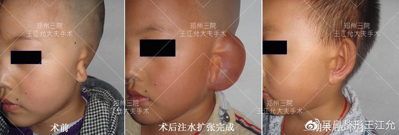 小耳畸形耳廓再造方法,耳畸形再造耳廓多少钱