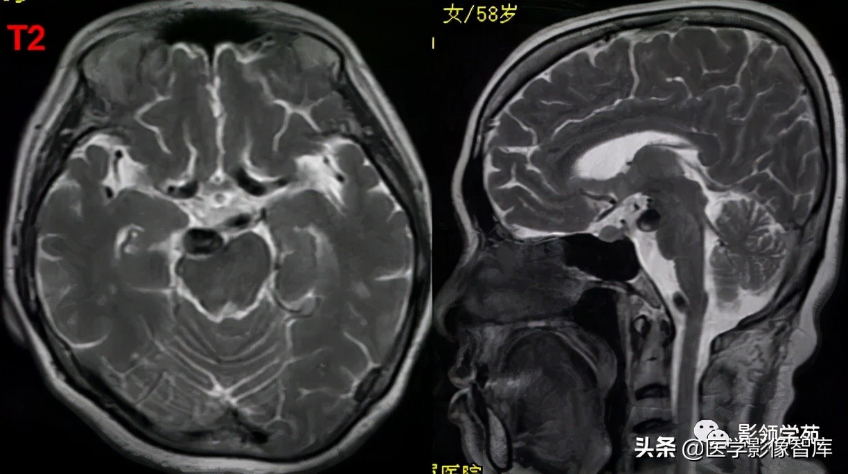 鞍区肿瘤做什么检查得出来,鞍区肿瘤的影像学鉴别