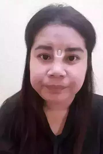 19岁女孩做隆鼻手术8小时内死亡,29岁女生隆鼻死亡真相调查