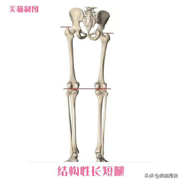 长短腿跟腿型能矫正吗,长短腿矫正锻炼方法左腿长右腿短