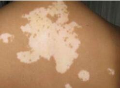 发现白斑怎么办,终于知道脸上长白斑是什么原因了