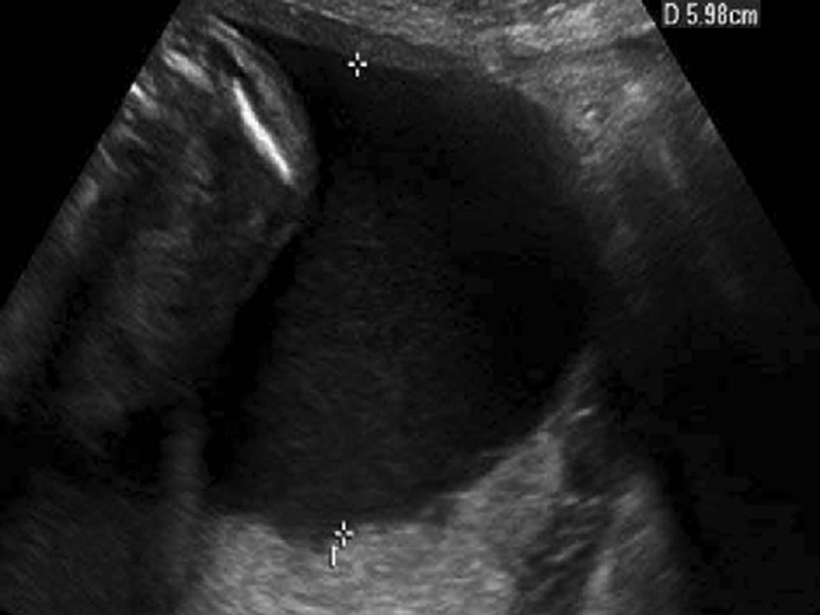 明明白白做超声（十九）：羊水和胎膜超声检查