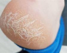 手足护理保湿方法,手足护理防干燥脱皮干裂