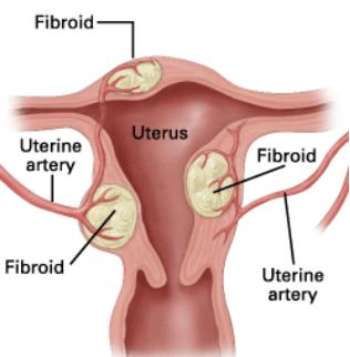 长子宫肌瘤跟贫血有关系吗,长子宫肌瘤气血不足长斑怎么调理