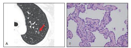 肺结节中的ggo代表什么,肺结节ggn与ggo有什么区别
