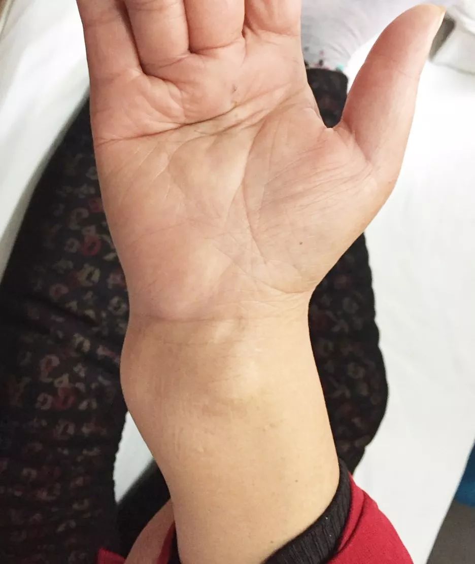 许昌阿姨怪病,84岁老人突然查出恶性肿瘤