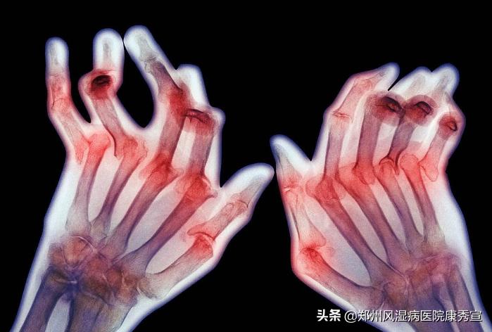 老年人吹空调会得风湿病,老人有风湿不能吹空调怎么办