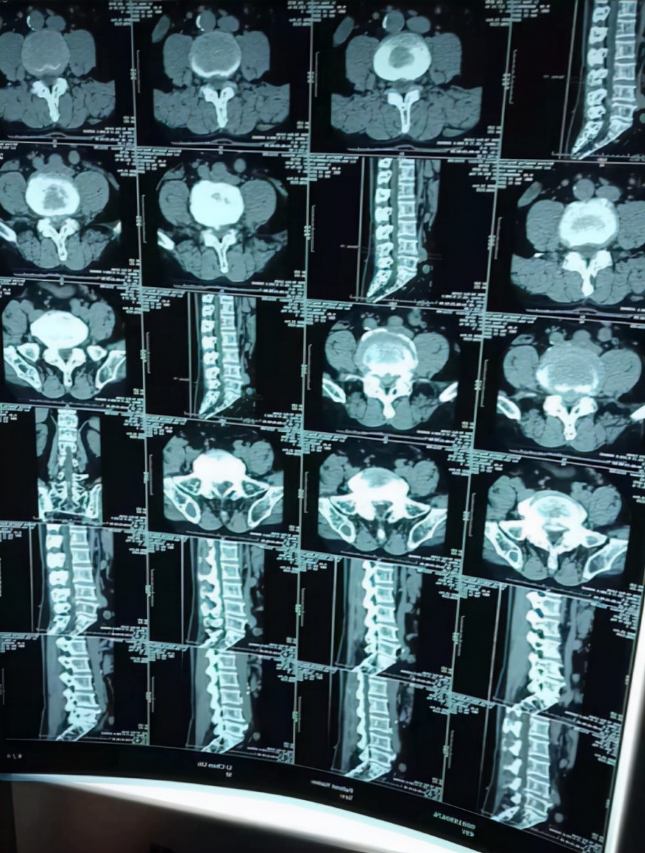 腰椎管狭窄的病例,腰椎管狭窄成因和治疗方法