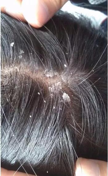 木北头皮：夏季头发油腻原因分析