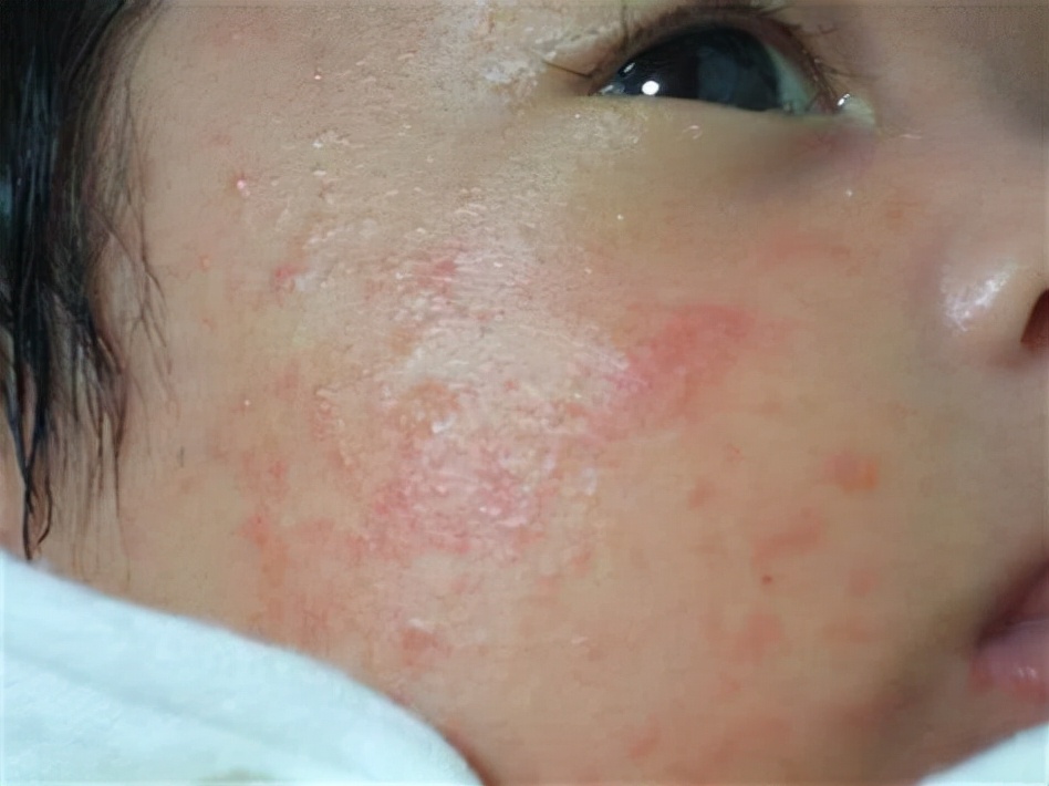 战痘的正确方法图解,五个“战痘”小妙招