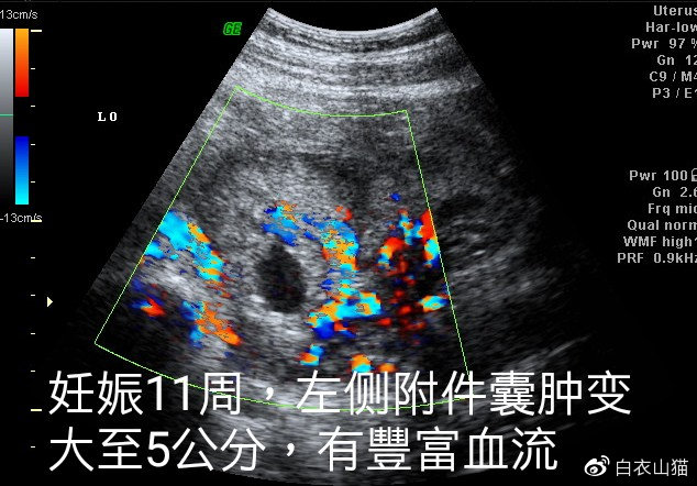 双胞胎一个宫内一个宫外大出血,双胞胎一个流产一个宫外孕