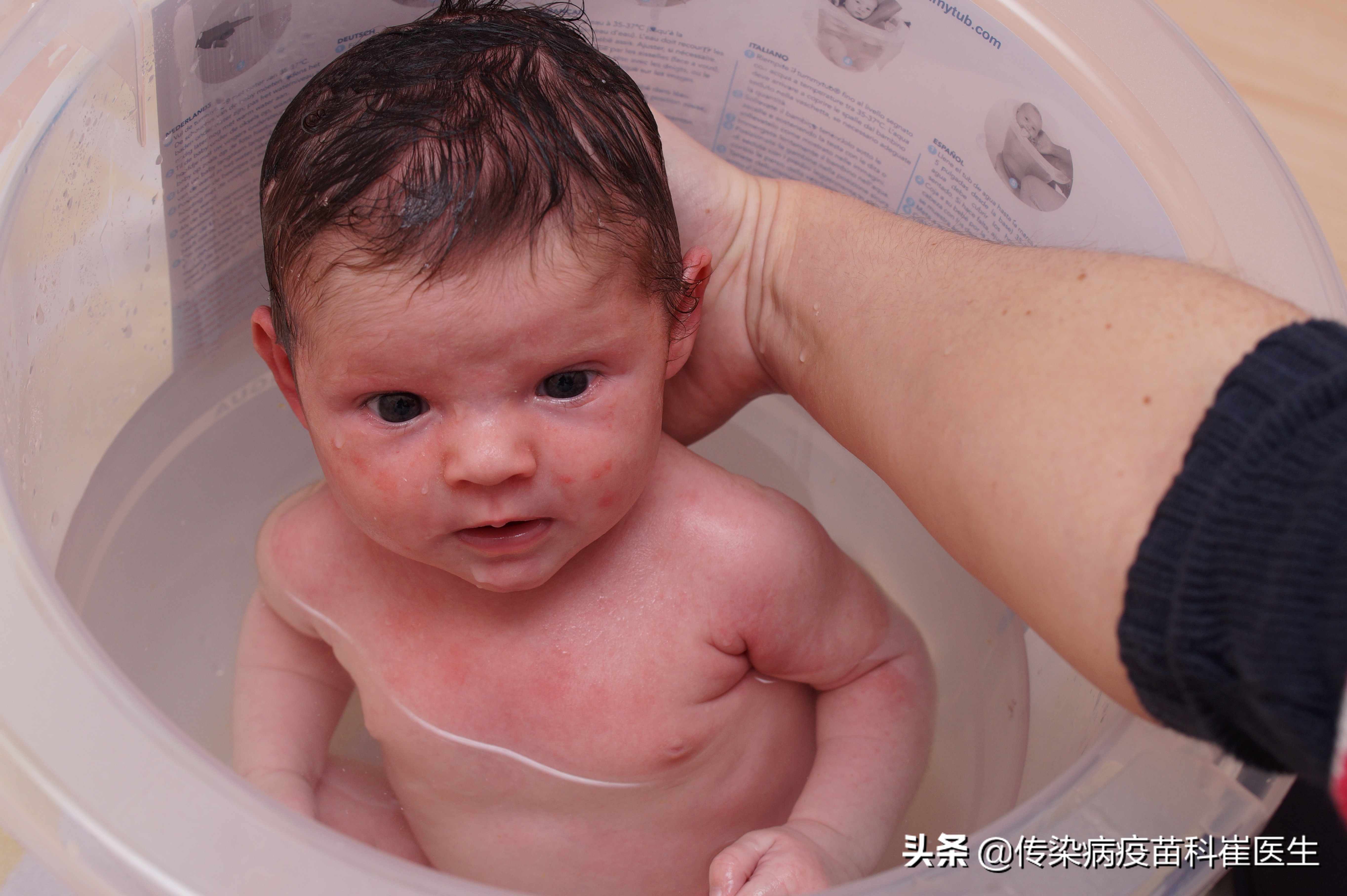 秋冬季怎样预防过敏性紫癜复发,过敏性紫癜什么情况下可以自愈