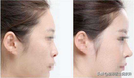 为什么打了玻尿酸还是没效果,打玻尿酸和不打十年以后区别