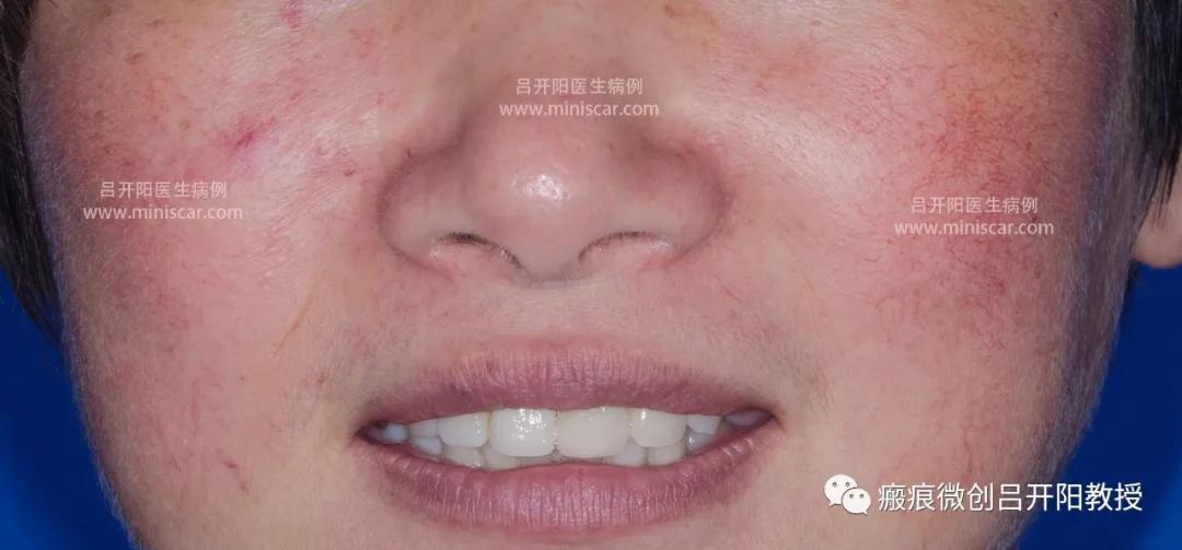 强脉冲激光治疗脸部视频,点阵激光嫩肤