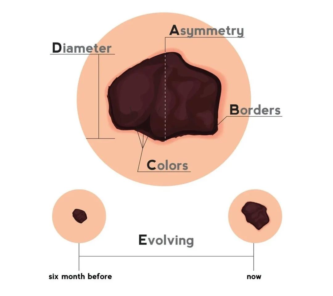 面积大的痣一定是黑色素瘤吗,恶性雀斑样痣与黑色素瘤