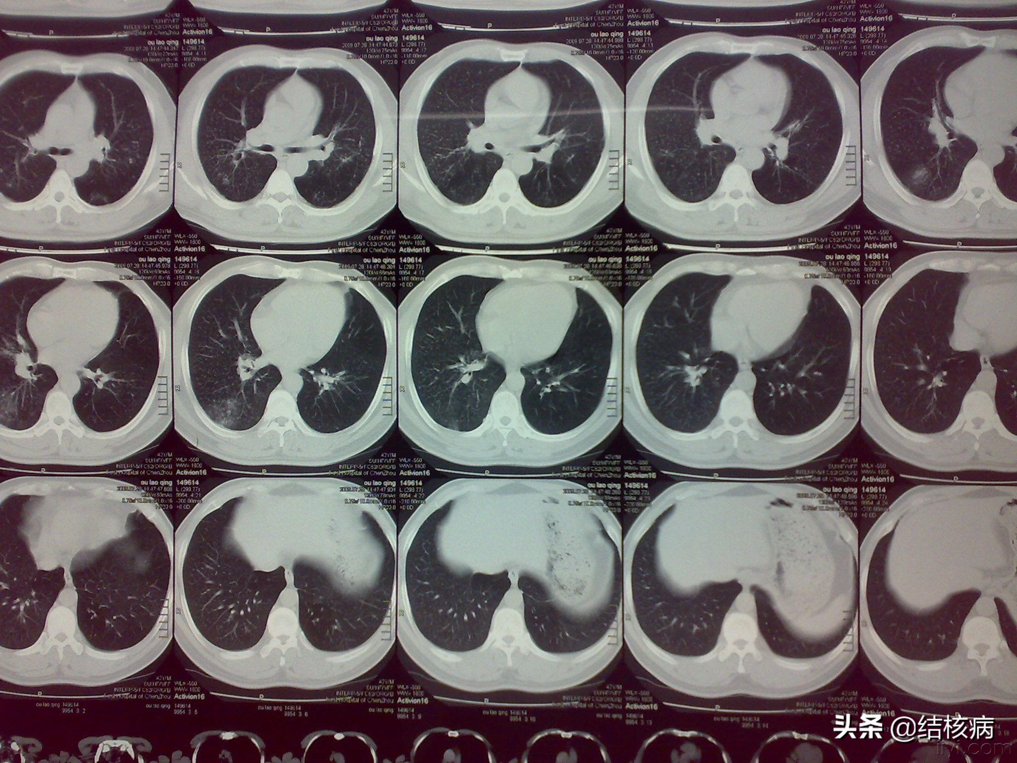 肺结核伴支气管结核严重吗,肺结核病灶有什么危害
