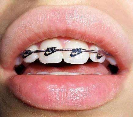 戴牙套不一定变好看,拔牙后戴牙套难看怎么办