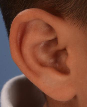 余文林耳科医生,余文林小耳畸形失败案例