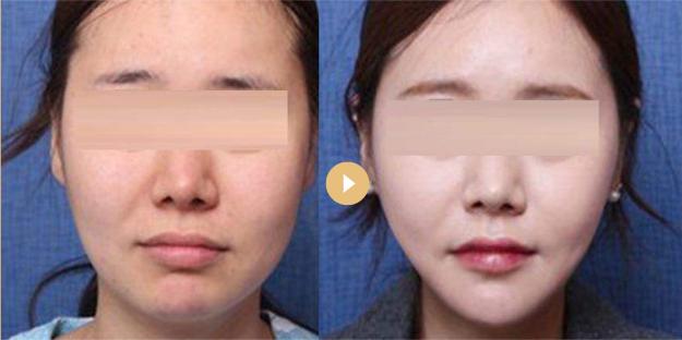 娃娃脸婴儿肥怎么瘦,怎么区分双下巴和婴儿肥