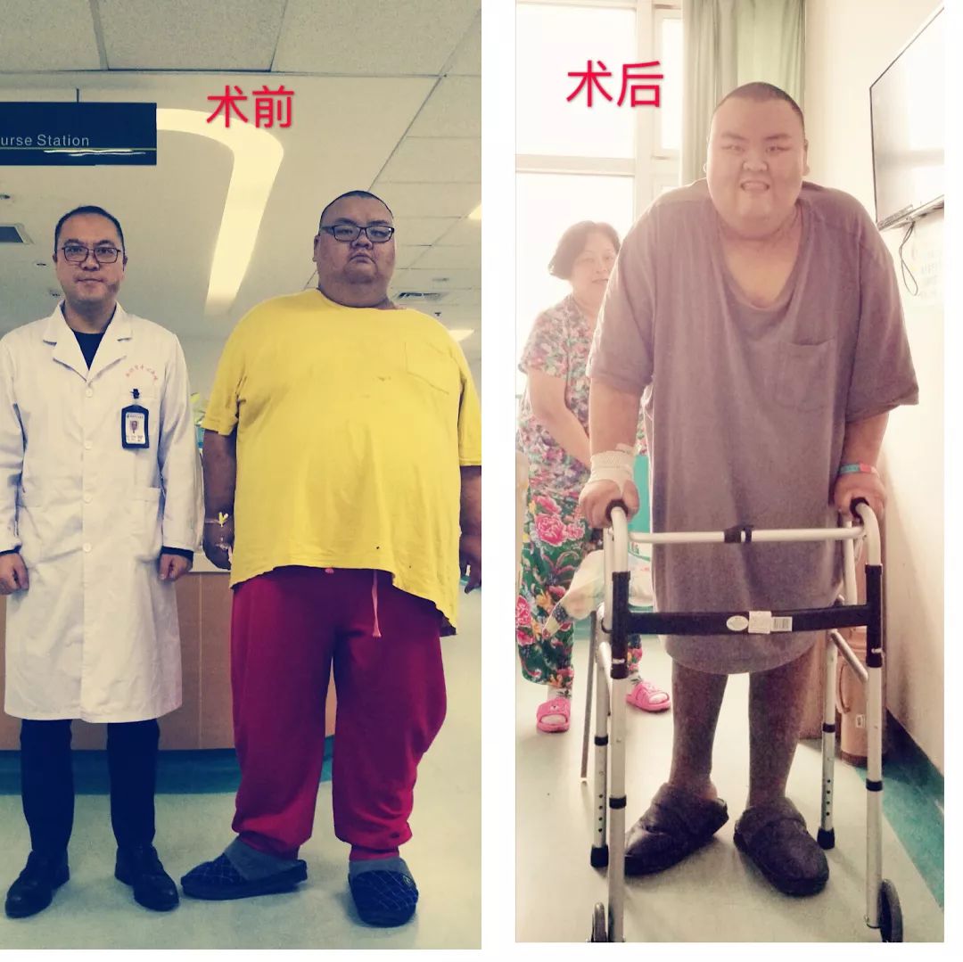 500斤大胖子做缩胃手术减肥,缩胃减肥首月成功减重40斤