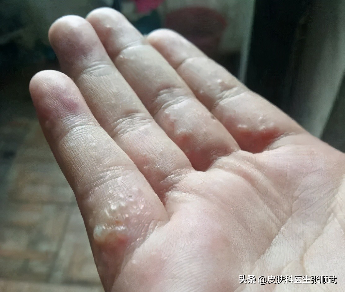 手上小水泡汗疱疹,脚上手上起小水泡很痒可以根治吗