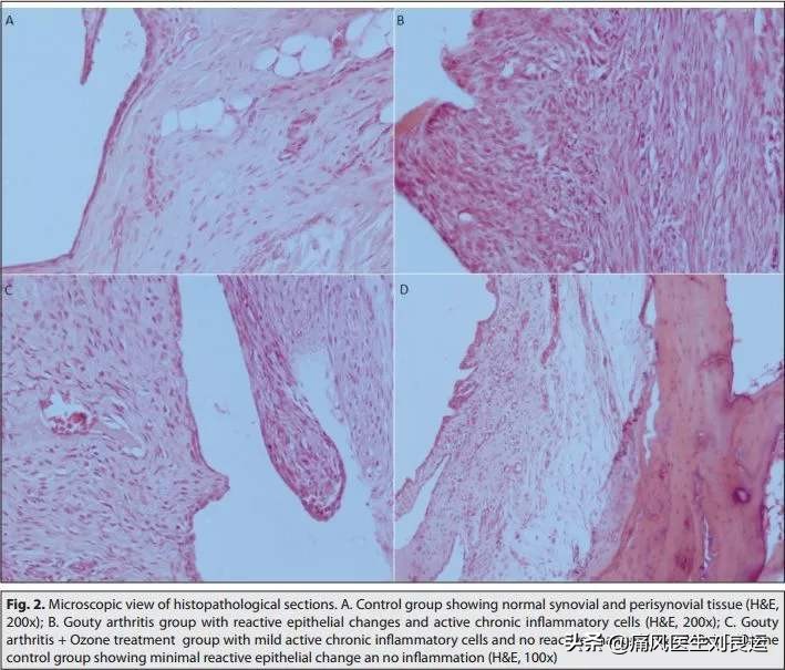 尿酸高除了注意饮食还需要什么,尿酸高有什么办法预防痛风发作