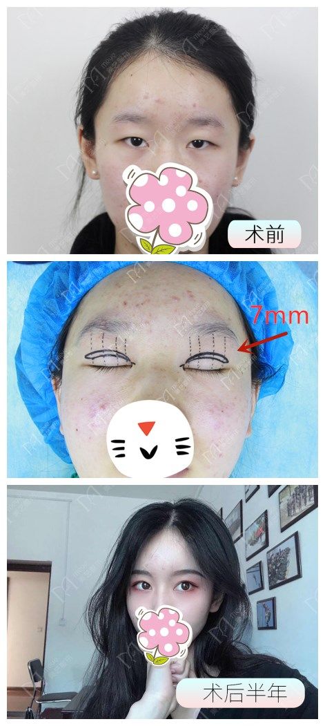 10毫米双眼皮可以恢复自然不,割双眼皮7.5毫米和8毫米的区别