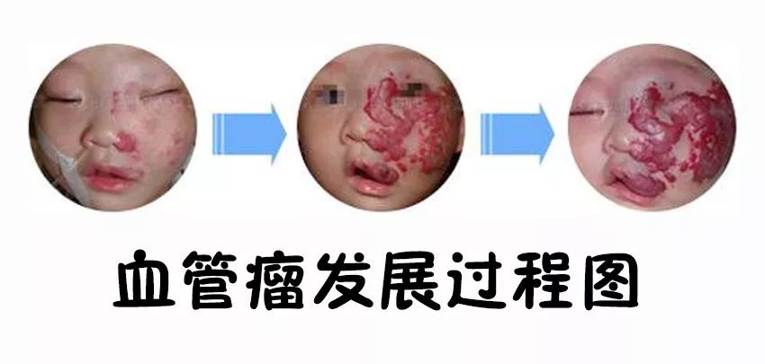 新生儿红胎记与血管瘤区别,红胎记血管瘤的最佳消除方法