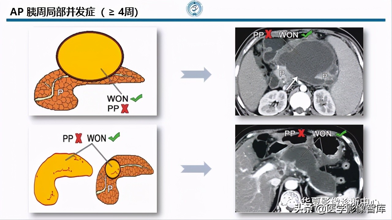 核磁ct都显示急性胰腺炎,急性坏死性胰腺炎的ct表现