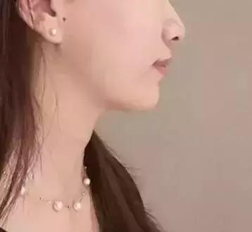 明星注射玻尿酸案例,注射玻尿酸变美