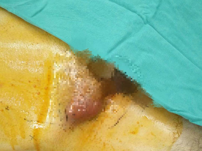 男性腹股沟长了小肉瘤,中年男性腹股沟区肿物疼