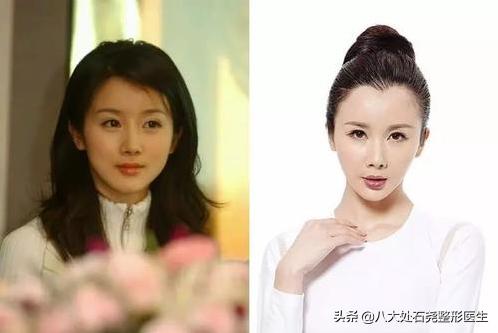 明星太阳穴凹陷怎么解决,太阳穴填充的明星