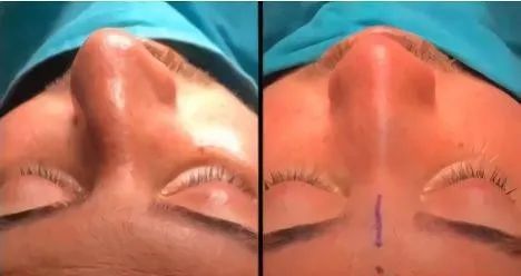 歪鼻有必要改善吗,歪鼻改善