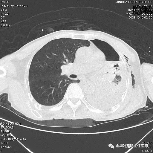 手术引起乳糜胸,有没有做了肺结节手术后是误诊的