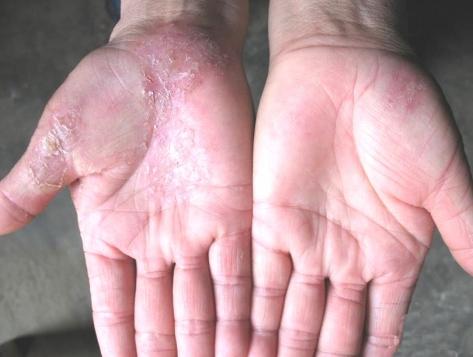 远离真菌感染,真菌性皮肤病的克星
