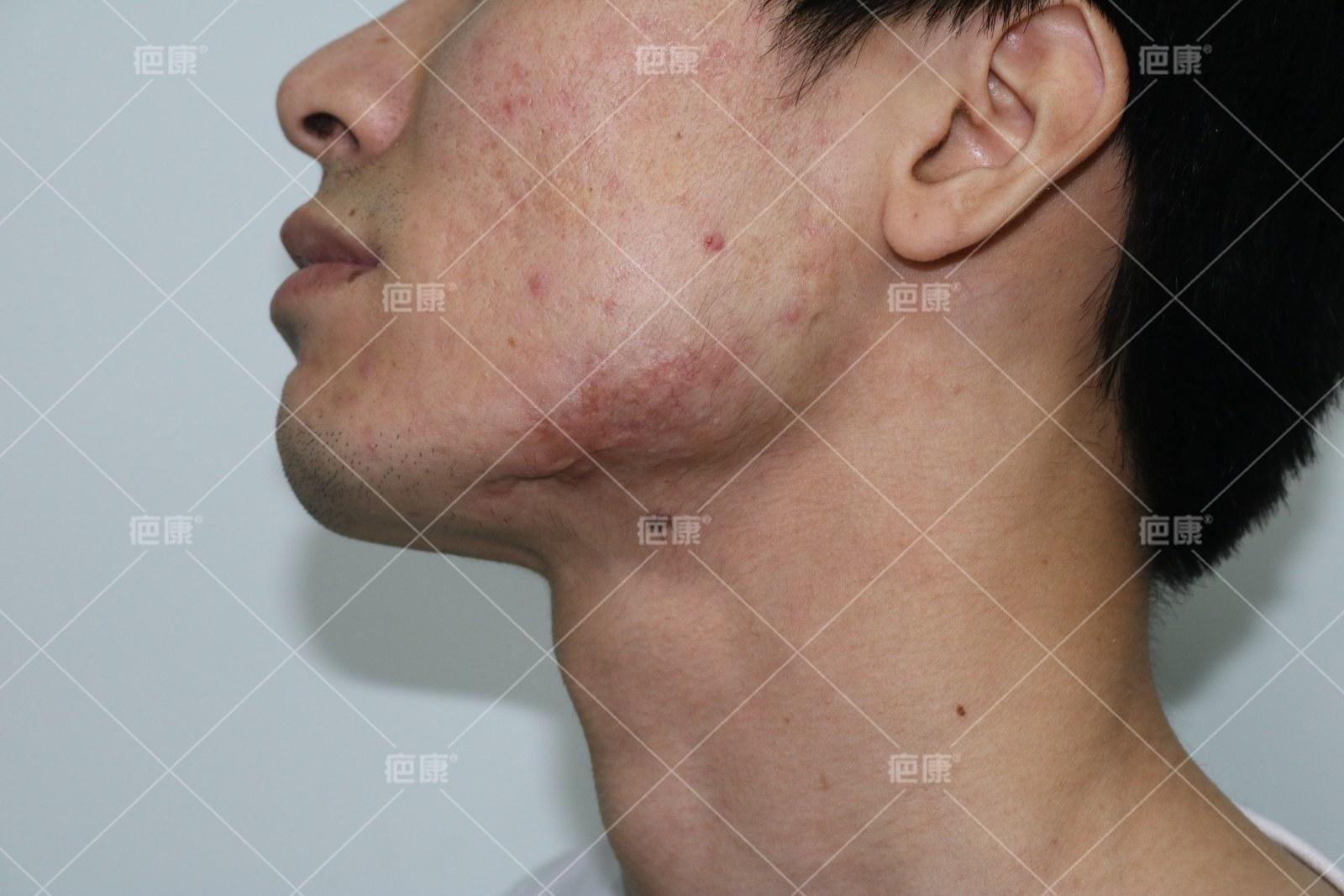 疤康净有效吗,疤康医院能治疤痕疙瘩吗