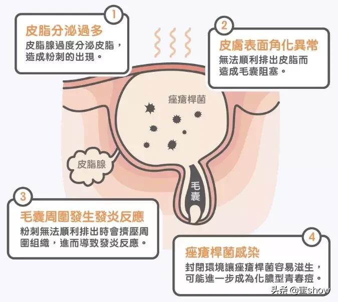 皮肤痘怎么消除,解决皮肤问题对策