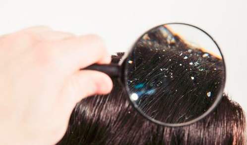 头皮屑多怎样解决最有效,头皮屑多怎么办最有效