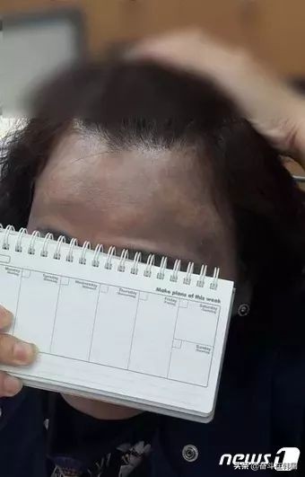 太惨了！这起染发*案惨**在韩国又双叒发生了