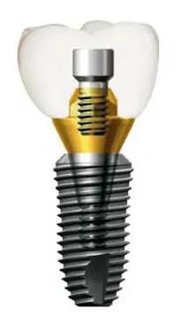 种植牙三年内坏了给赔偿吗,种植牙几年后坏了怎么办