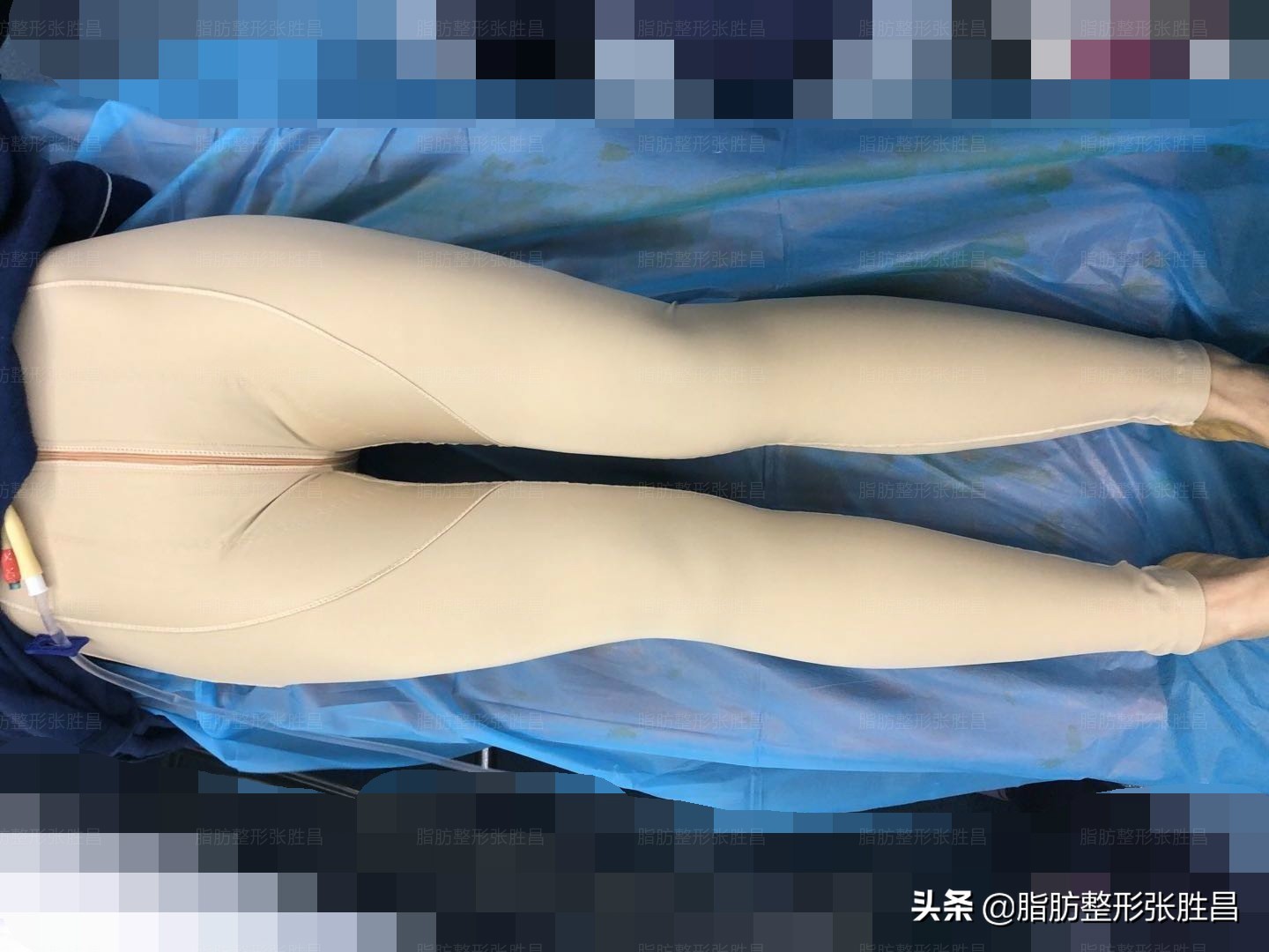 大腿环吸多长时间减腿围,大腿环吸后如何更好塑形