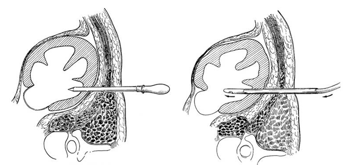 左肾穿刺造瘘术后护理目标,经皮肾穿刺造瘘术是微创吗