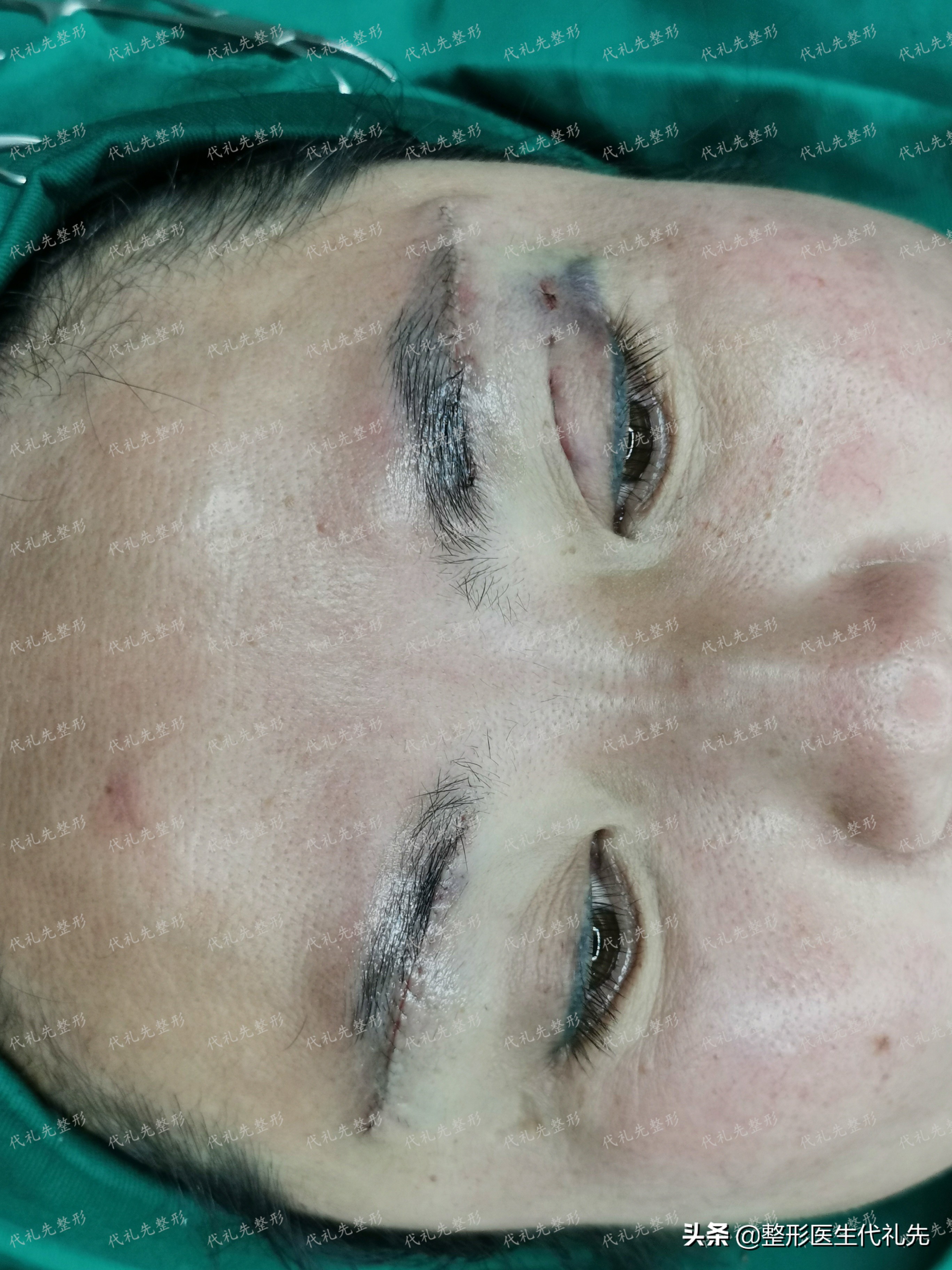 50岁做提眉眼袋手术能保持多久,提眉去眼袋手术15天图片