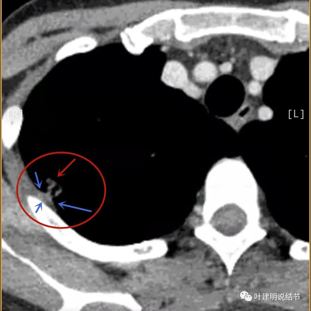 临床诊断孤立性肺结节,空洞型结节一般是什么性质
