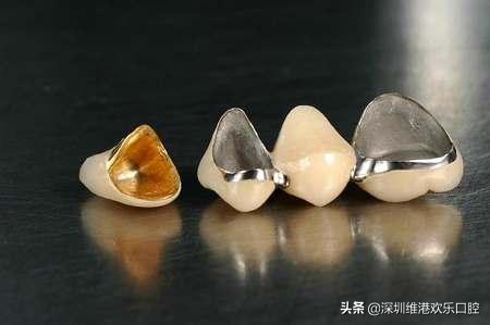 全瓷牙和烤瓷牙的区别一颗价格表,全瓷牙和烤瓷牙的区别和价格