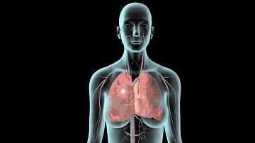 关节置换有什么副作用吗,关节置换后为啥要防感染