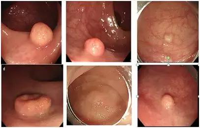 直肠神经内分泌肿瘤分级和治疗,直肠神经内分泌肿瘤到底是不是癌